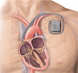 icd illustration 08780e